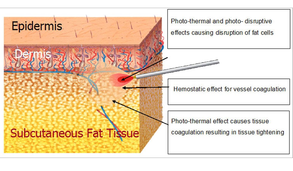 dermis